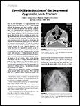 Towel Clip Reduction of Depressed Zygomatic Arch Fractures.